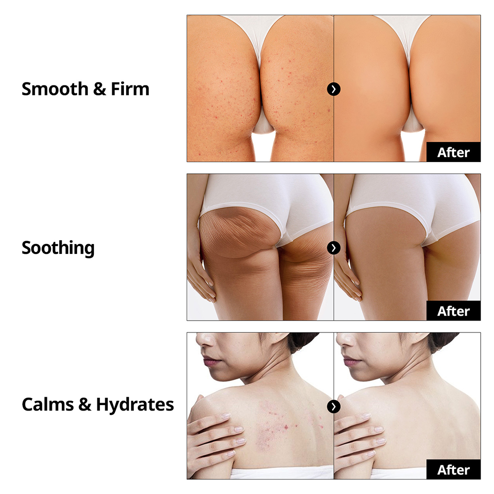 BnD Butt Premium Treatment Cream 100ml | OLIVE YOUNG Global