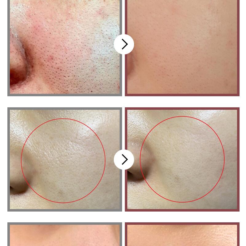うめのみや☆ノエビア レニューロジック モイスチャーマスク 3枚入×3箱他 numbuzin No.3 Tingle-Pore Softening Sheet Mask 4+1 Special