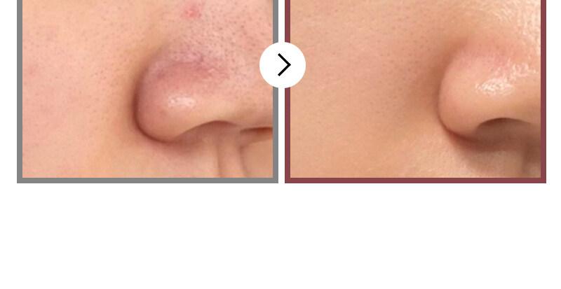 numbuzin No.3 Tingle-Pore Softening Sheet Mask 4+1 Special