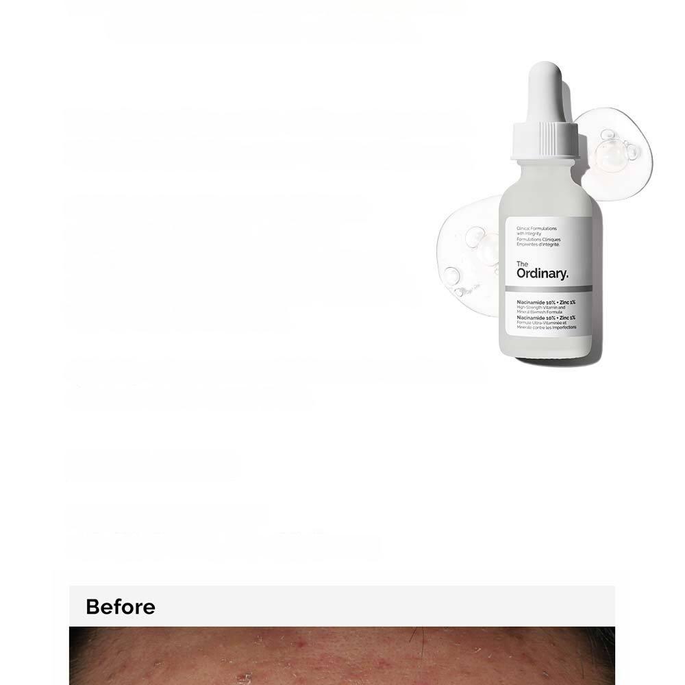 The Ordinaryスキンサポートセット(ナイアシンアミド10%+ジンク1% 30ml